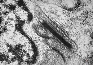 M,1y. | intramitochondrial inclusion - plexus papilloma M,1y. | intramitochondrial inclusion - plexus papilloma